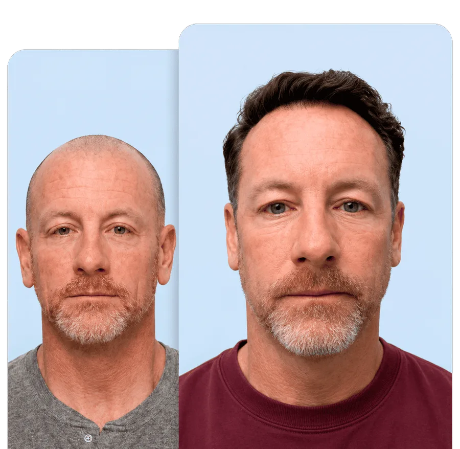 Before and after hair restoration