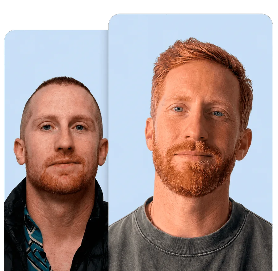 Before and after hair restoration